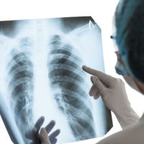 new york mesothelioma claims